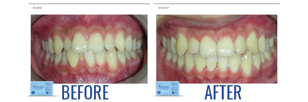 in-house clear aligners